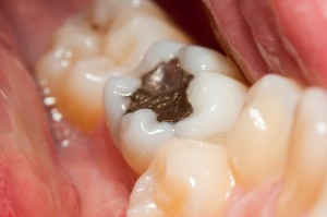 Amalgam filling